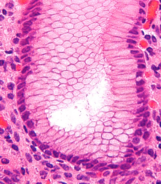 Gastritis helicobacter - very high mag cropped