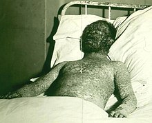 Likely hemorrhagic smallpox during a 1925 Milwaukee, Wisconsin epidemic in a patient who later died. Patient described as an unvaccinated Christian Scientist, who "thought that he could by power of mind prevent smallpox." Hemorrhagic smallpox 2 (cropped).jpg