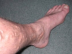 ساق شخص مصاب بدوالي وريدية