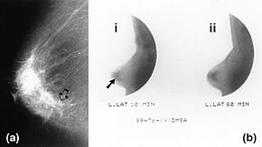 Маммография и наука ntimammography of carcinoma.jpg 