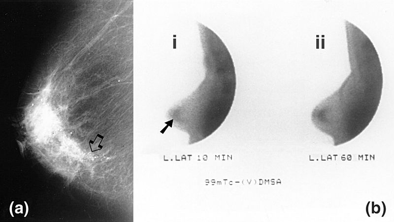 File:Mammography and scintimammography of carcinoma.jpg