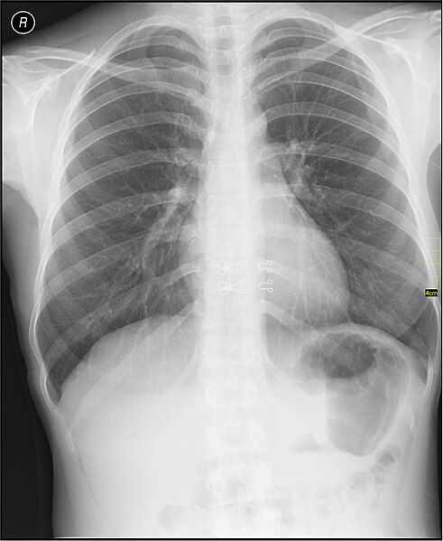 File:Medical X-Ray imaging AJY02 nevit.jpg