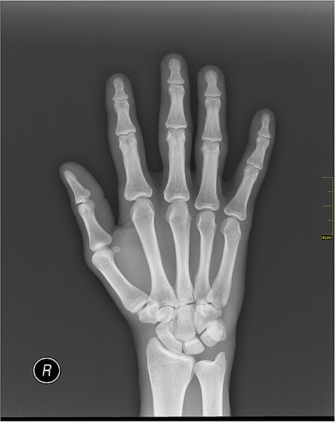 File:Medical X-Ray imaging WBY07 nevit.jpg