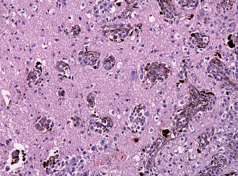 File:Melanoma infiltrating the brain.jpg