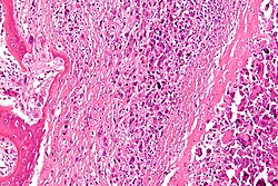 צילום מיקרוסקופי של סרטן ראשוני מסוג אוסטאוסרקומה