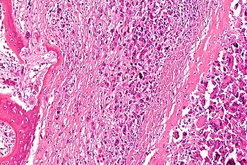 Micrograph of an osteosarcoma, a malignant primary bone tumor.