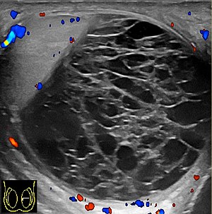 Scrotal Ultrasound