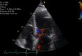 File:The-best-of-2005-in-echocardiography-back-from-EuroEcho-9-–-Florence-Italy-1476-7120-4-11-S3.ogv