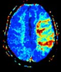 Thumbnail for Perfusion MRI