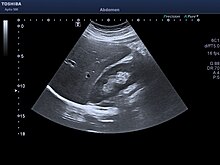 Adult ultrasound showing the right lobe of the liver and right kidney Ultrasound liver right lobe and right kidney.jpg