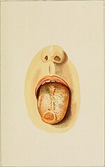 Thumbnail for File:A manual of syphilis and the venereal diseases, (1900) (14595835629).jpg