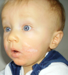 ילד עם דלקת עור אטופית