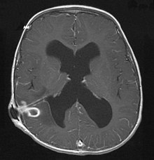 MRI (T1 with contrast) showing the ring-enhancing lesion. From a rare case report of an abscess formed as a complication of the CSF shunt. Jamjoom et al., 2009. Brain Abscess at MRI (T1 + contrast) -- showing a small ring-enhancing lesion with mild surrounding edema adjacent to the ventricular catheter and ventricular dilatation..jpg