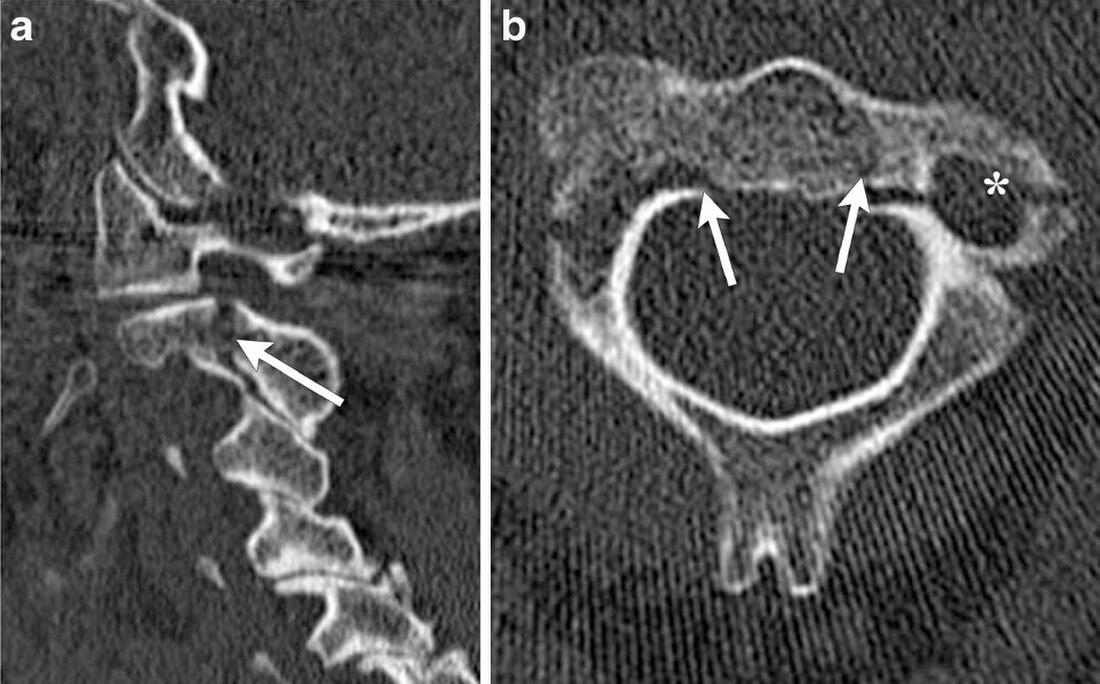 Hangman's fracture