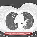 Imagen de corte de tomografía computarizada de ambos pulmones sin procesamiento.