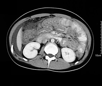 Spiral CT showing ascites and concentric thickening of colon and ileum in EG