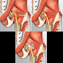 Fibrovascular bands are dense tissue that can restrict mobility of the sciatic nerve causing entrapment. Top left is a compressive / bridge-type band, like a seat belt. Top right is an adhesive / horse-strap band, like a leash. Bottom center is undefined distribution that restricts mobility in multiple directions, like a splattering of glue. Fibrovascular entrapment of the sciatic nerve.jpg