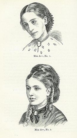 "Miss A-" afgebeeld in 1866 en na behandeling in 1870. Uit die gepubliseerde mediese geskrifte van sir William Gull.