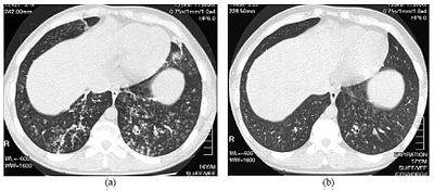 High resolution computed tomography (HRCT) images of the lower chest in a 16-year-old boy initially diagnosed with DPB (left), and 8 weeks later (right) after a 6-week course of treatment with erythromycin. The bilateral bronchiectasis and prominent centri-lobular nodules with a "tree-in-bud" pattern shows noticeable improvement. HRCT scans of diffuse panbronchiolitis.jpg