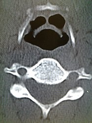 CT imaging showing the "halloween sign"