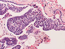 Examples Neuroendocrine cell hyperplasia (5019609181).jpg