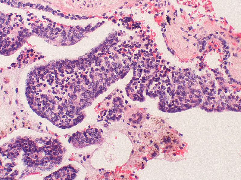 File:Neuroendocrine cell hyperplasia (5019609181).jpg