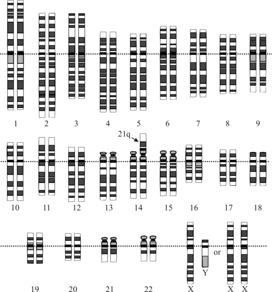 File:Robertsonian translocation rob(14;21).png