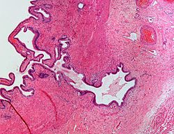 صورة مجهرية تظهر جيوب روكيتانسكي - آشوف مصبوغة بصبغة الهيماتوكسيلين واليوزين.