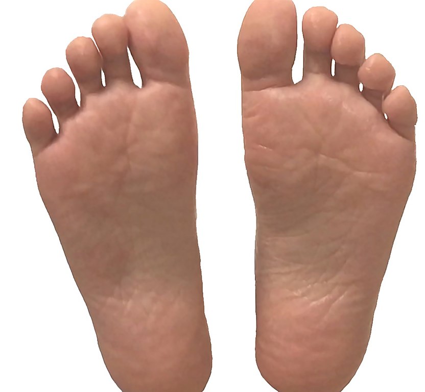 File:Soles of the feet.jpg - Wikimedia Commons