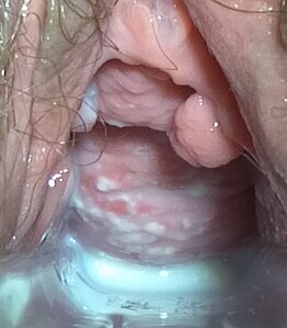 Speculum exam in candidal vulvovaginitis, showing thick, curd-like plaque on the anterior vaginal wall. A slightly erythematous base is visible close to the center of the image, where some of the plaque was scraped off]]