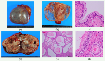 (a-c) Seromucinous cystadenoma. A thin-walled paucilocular cyst filled with thin mucinous clear fluid. The cyst wall is lined by endocervical-type columnar mucinous cells admixed with scattered ciliated cells. (d-f) Seromucinous adenofibroma. Mostly solid mass with scattered cystic spaces. Squamous Ovarian Cell Carcinoma.png