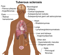 Symptoms and signs of tuberous sclerosis Symptoms and signs of tuberous sclerosis.png