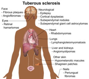 Symptoms and signs of tuberous sclerosis.png