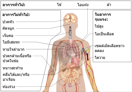 ไฟล์:Symptoms of coronavirus disease 2019 2.0-th.svg