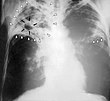 Tbc-s beteg mellkasi röntgenképe