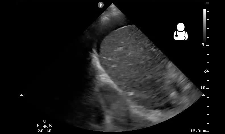 File:UOTW 32 - Ultrasound of the Week 3.webm