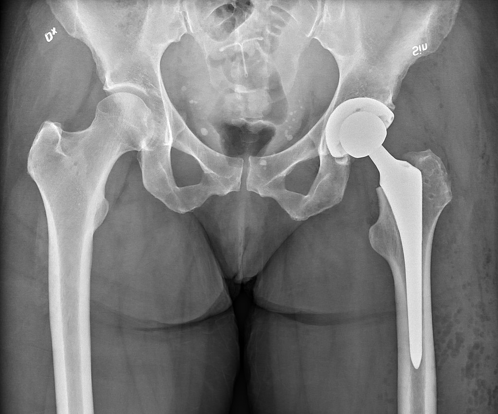 1024px X ray of pelvis with total arthroplasty Geleceğiniz Sizin Elinizde Hasta geliyor, minimum 5 yıllık, ortalama 10 -30 yıl sürmüş jinekolojik şikayetleri nedeniyle canı yanmış, ''hızlı ve etkili ve de ucuz'' tedavi ile adeta şip şak iyileşeceğini beklerken; mevcut durumunun ciddi + masraflı olduğunu anladığında hemen şunu sormaktadır: