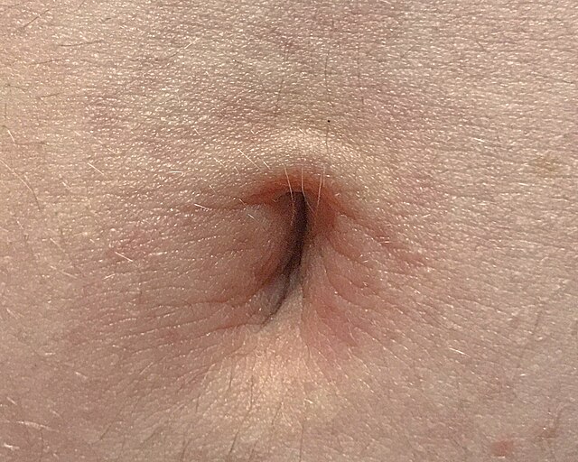 Inverted nipple - Wikipedia