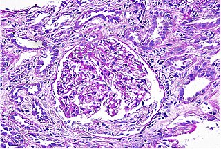 Interstitial nephritis type of nephritis affecting the interstitium of the kidneys surrounding the tubules