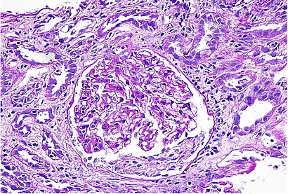 Acute Interstitial Nephritis.jpg