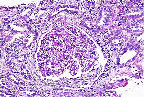 Interstitial nephritis