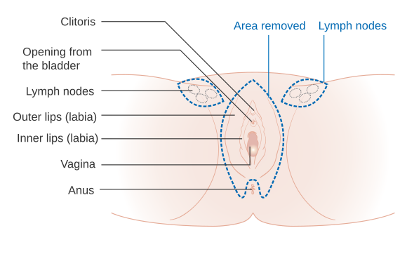 Diagram of the incisions made in a vulvectomy, a treatment for vulvar cancer