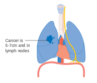 Diagram showing one option for stage 2Ba lung cancer CRUK 176.svg