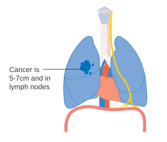 File:Diagram showing one option for stage 2Ba lung cancer CRUK 176.svg