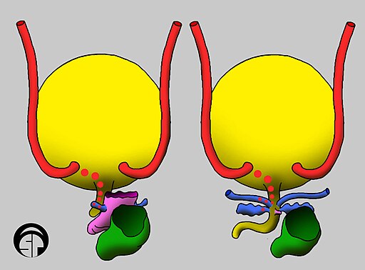 Ectopic Ureter Positions