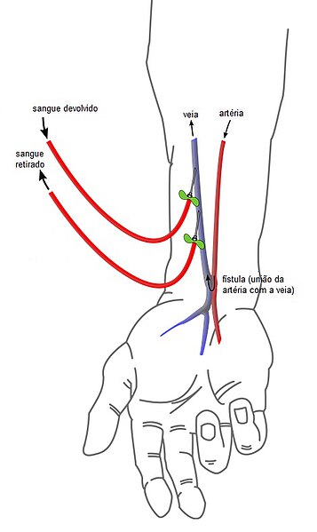 File:Esquema de fístula para hemodiálise.jpg