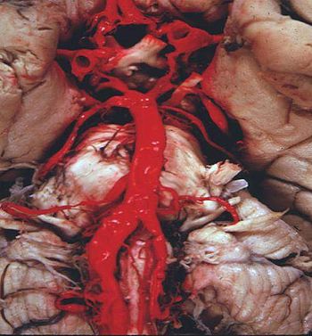 Human base of brain blood supply.JPG