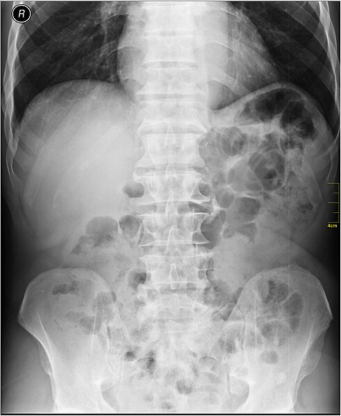 File:Medical X-Ray imaging XCA07 nevit.jpg