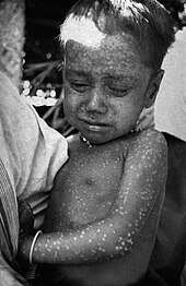 Three-year-old Rahima Banu of Bangladesh (pictured) was the last person infected with naturally occurring variola major, in 1975. Rahima Banu.jpg
