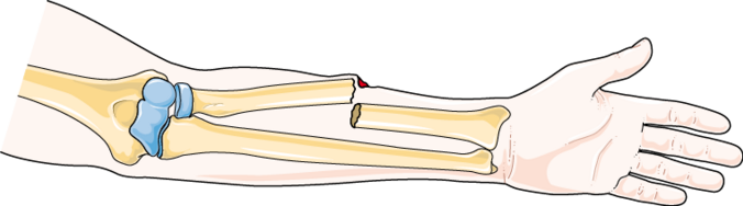 Diagram of an open, transverse, midshaft radius fracture Rheumatology - Open fracture -- Smart-Servier.png